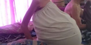 Wanita asal Cimohong ini Derita Tumor Perutnya Selama 14 Tahun