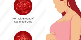 Anemia: Si “Silent Killer” Bagi Ibu Hamil